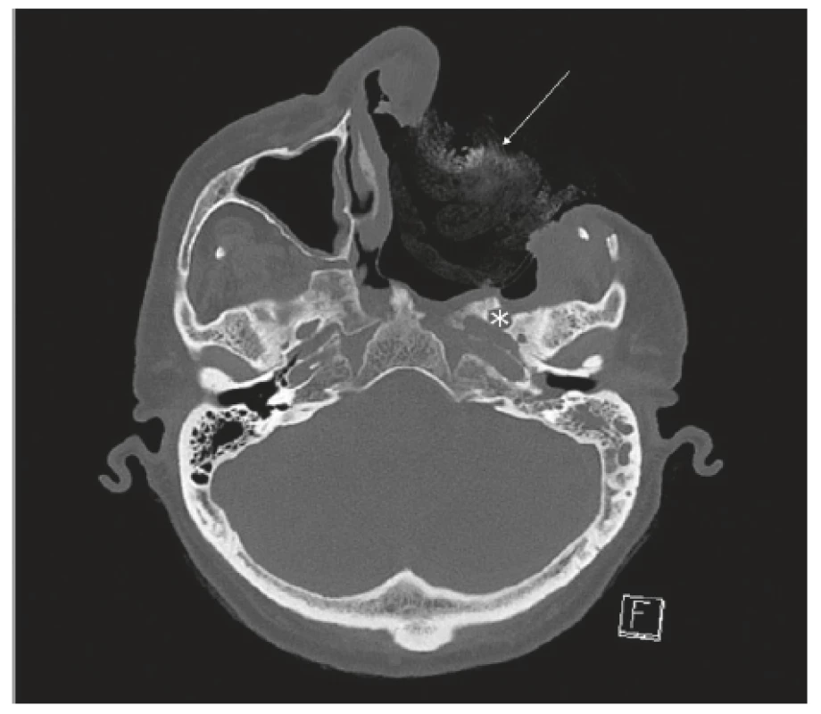 CT projekce, pooperační stav, trepanační dutina vyplněná
tamponádou (viz šipka), zadní hranice resekce při foramen
ovale (viz *).