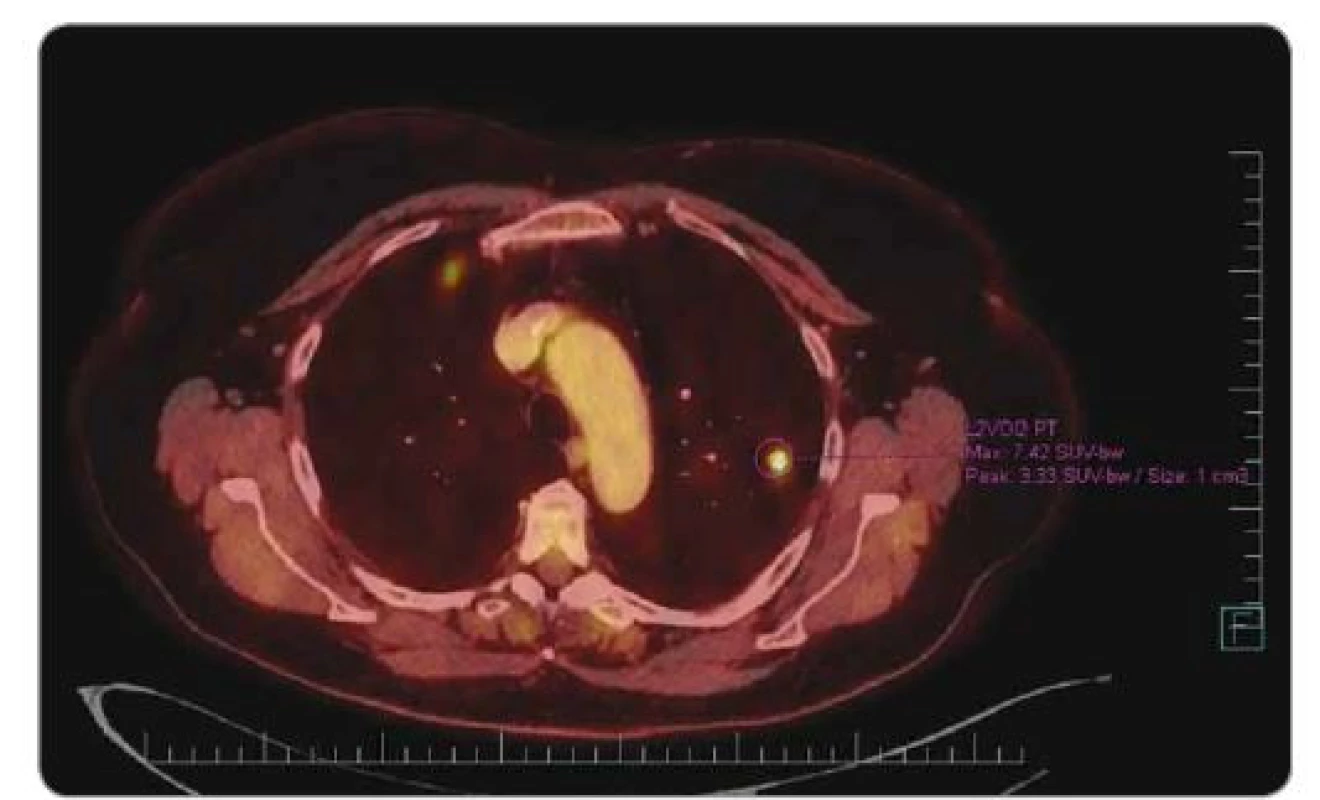 PET/CT v 11/2017. Plicní metastázy, ložiska v obou plicích, největší vpravo u mediastina
2 cm, ostatní velikosti 1 cm, před zahájením léčby Lonsurfem®.