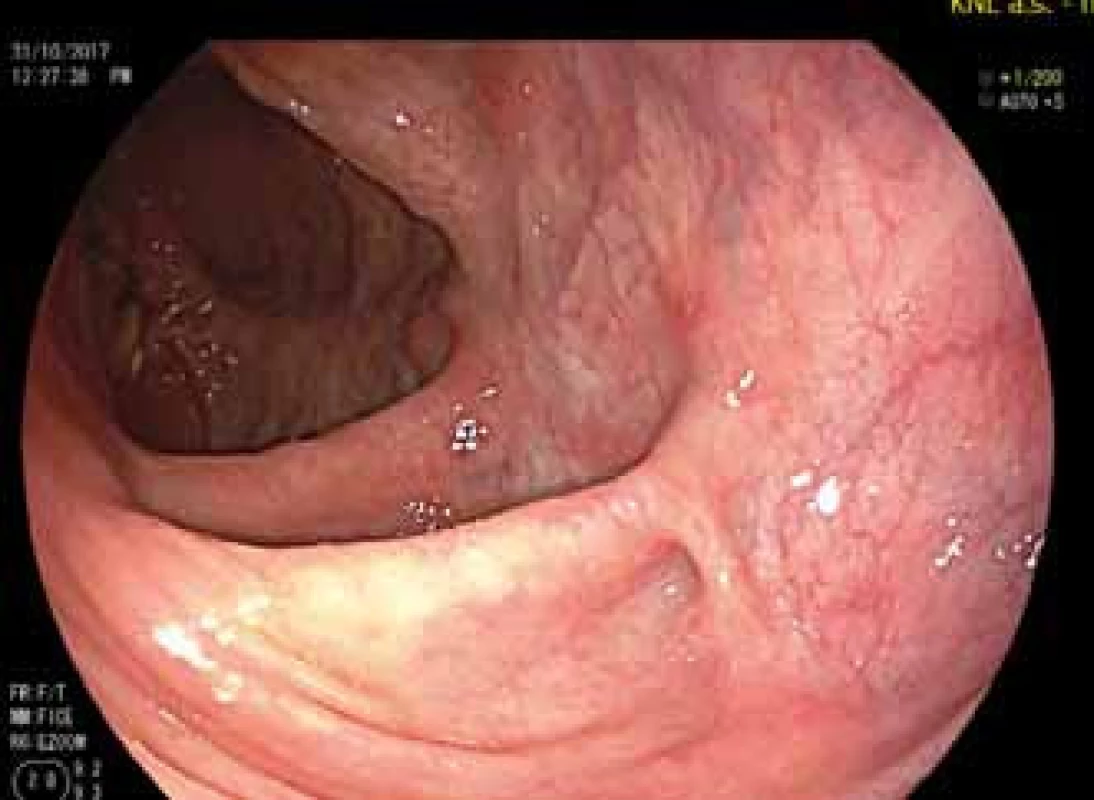 Pahýl rekta během léčby
ustekinumabem.<br>
Fig. 3. The rectal stump during
treatment with ustekinumab.