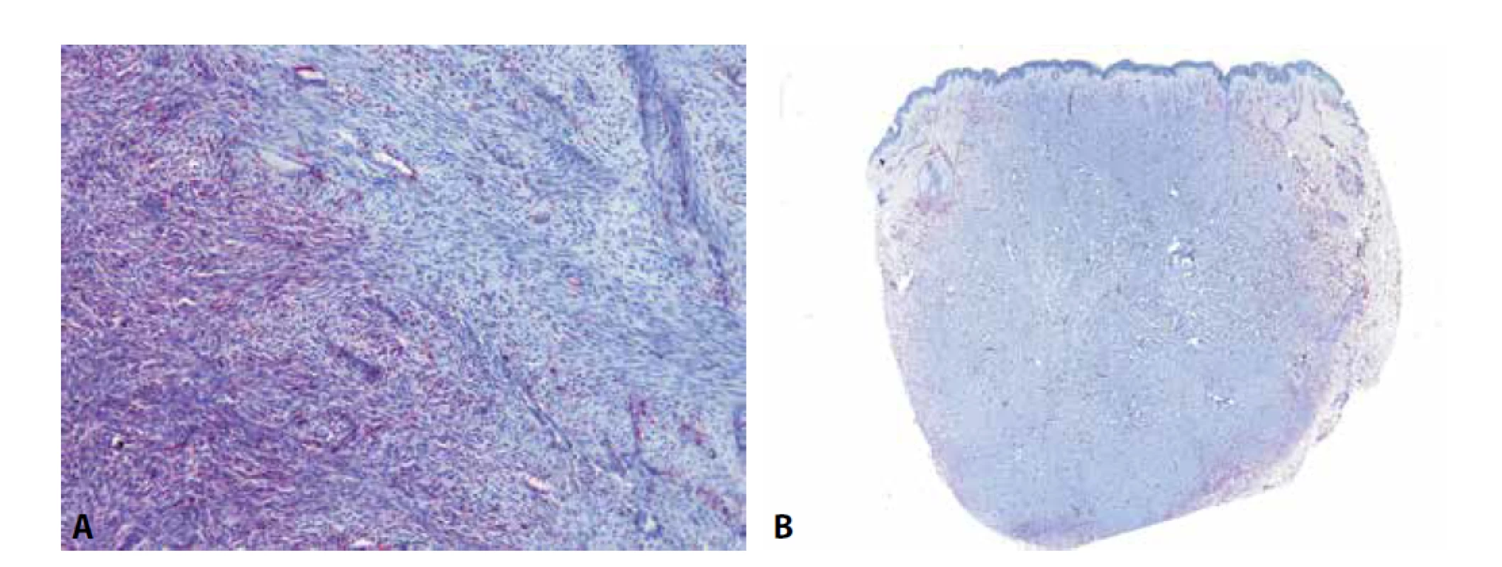 U dermatofibrosarcoma protuberans (DFSP) je možné pozorovat difúzní expresi CD34 v low-grade oblastech (A - vlevo) a její ztrátu v převážně
fascikulárně rostoucích high-grade oblastech (A – vpravo). Ke ztrátě exprese v těchto partiích dochází ve zhruba polovině případů a může
být nápomocná ke stanovení diagnózy fibrosarkomu ex DFSP. Protilátka CD34 je též užitečná k odlišení DFSP od benigního fibrózního histiocytomu.
U fibrózních histiocytomů, zejména pak u jeho celulárních forem, je exprese CD34 někdy také přítomna, ale téměř vždy pouze na periferii
tumoru, zatímco v jeho centru, na rozdíl od DFSP, chybí (B).