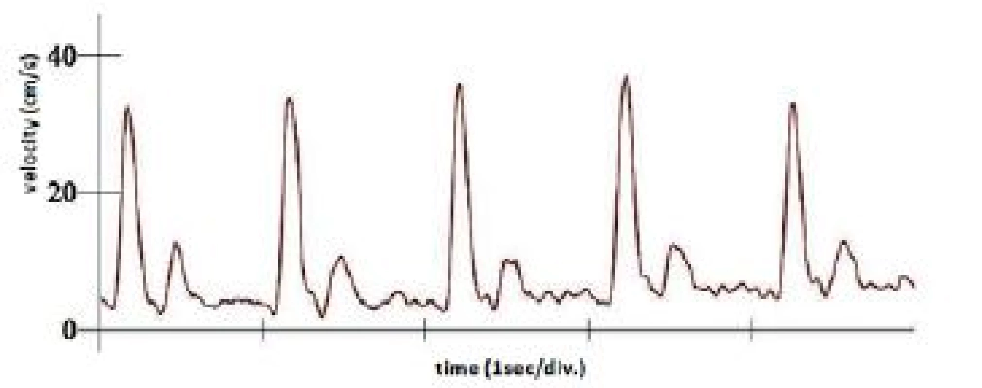 Typical appearance of resting velocity waveforms.