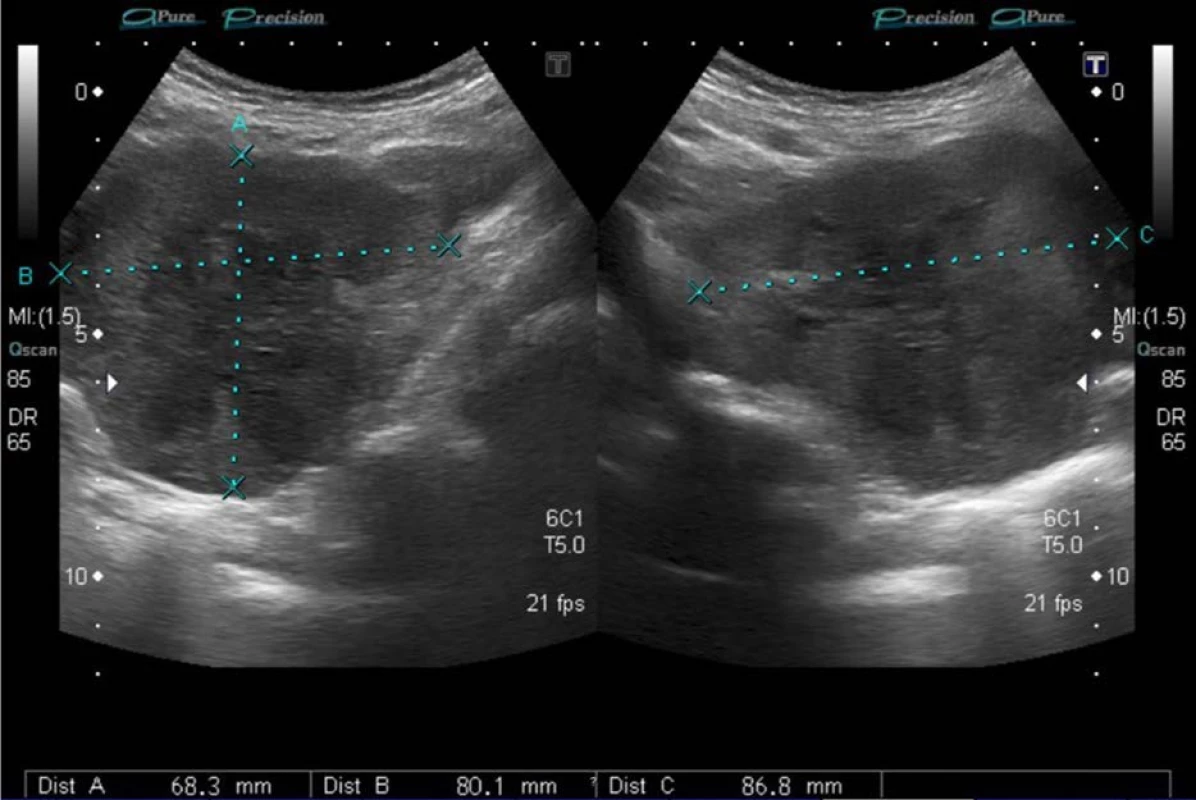 USG vyšetření břicha – recidiva v lůžku po levostranné nefrektomii<br>
Fig. 2. Ultrasound scan – local recurrence after left nephrectomy