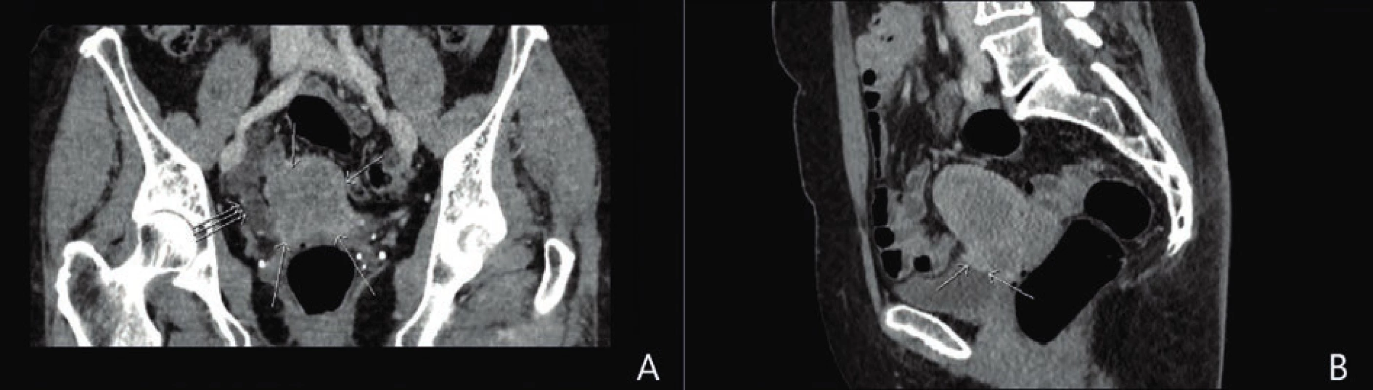 CT pánve v koronární a sagitální rovině.<br>
A: V koronární rovině patrná nehomogenní měkkotkáňová expanze v oblasti dělohy (→), dilatace distálního úseku pravostranného ureteru ( )
s obstrukcí v úrovni křížení ureteru a tumoru dělohy.<br>
B: V sagitální rovině děloha celkově nezvětšená, naznačené nehomogenní ložisko ve ventrální části krčku dělohy s infiltrací kraniální stěny
močového měchýře (→).