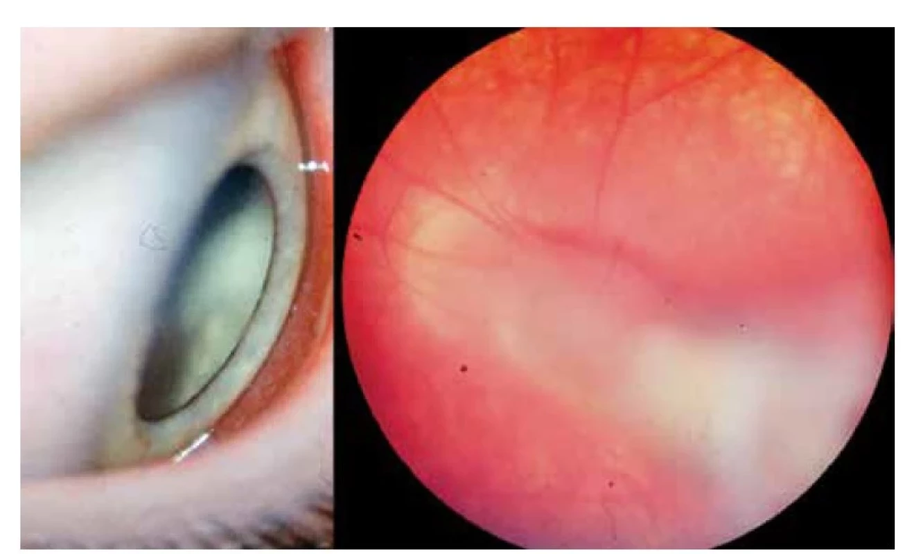 Vlevo: Difúzní periferní vitreoretinální zánet toxokarové etiologie<br>
Vpravo: Trakční vitreální pruh toxokárového granulomu táhnoucí se z periferie sítnice
k papile zrakového nervu