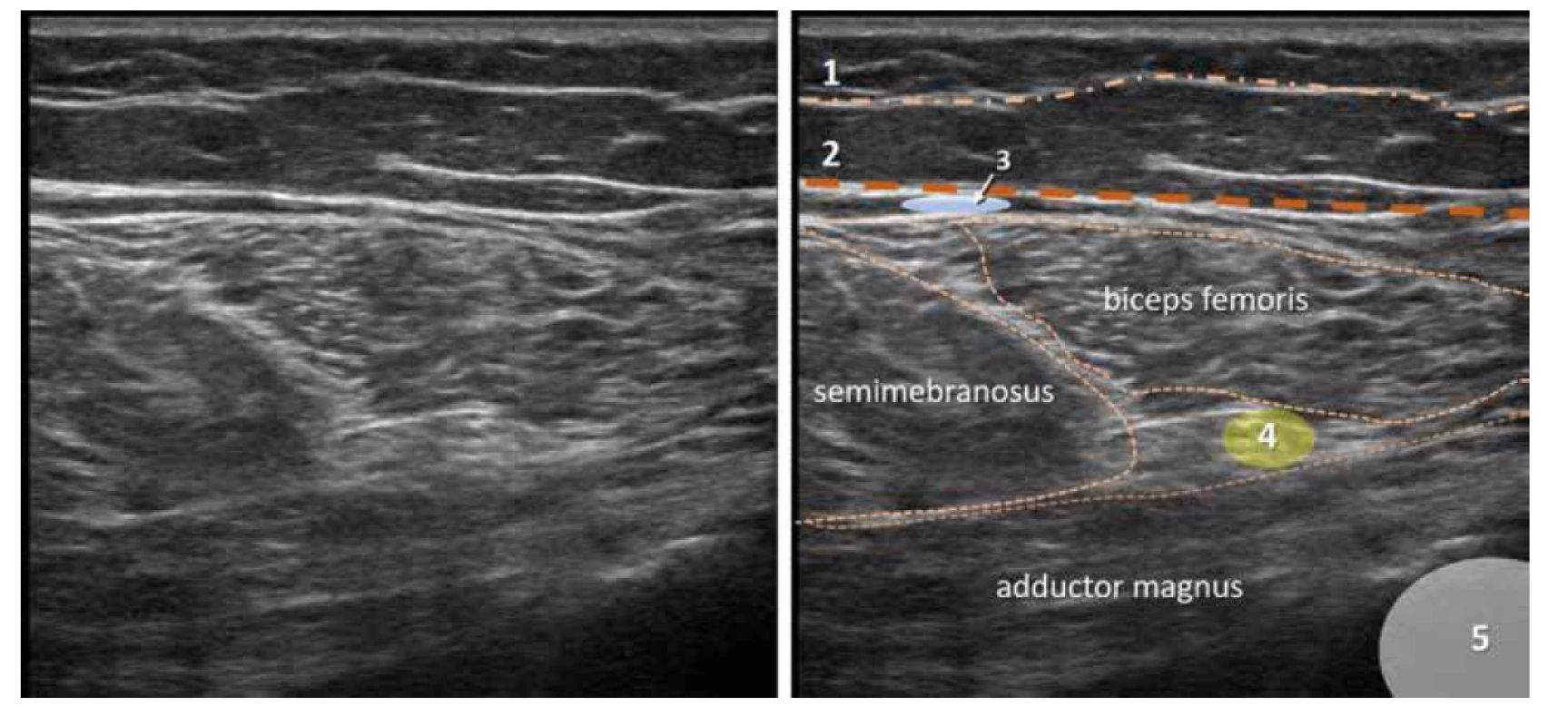 Nativní a kolorovaný ultrazvukový obraz zadní proximální části stehna. 1. povrchní fascie, 2. fascia lata, 3. místo pro aplikaci lokálního anestetika
pro blokádu NCFP, 4. n. ischiadicus, 5. femur