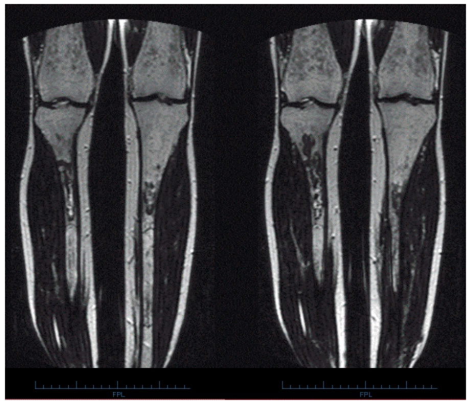 Střádání v kostní dřeni dlouhých kostí na MR u pacienta
s Gaucherou chorobou I. typu