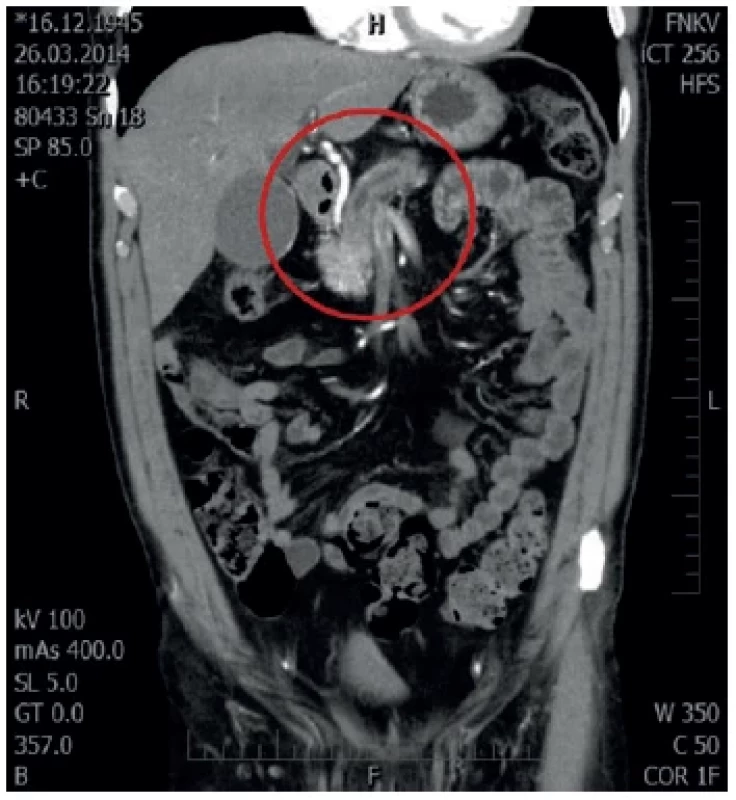 MDCT s nálezem duble duct sign
V červeném kruhu dilatace d. Wirsungi. <br> 
Fig. 3: MDCT with double duct sign
Dilatation of the pancreatic duct is captured in the red circle.