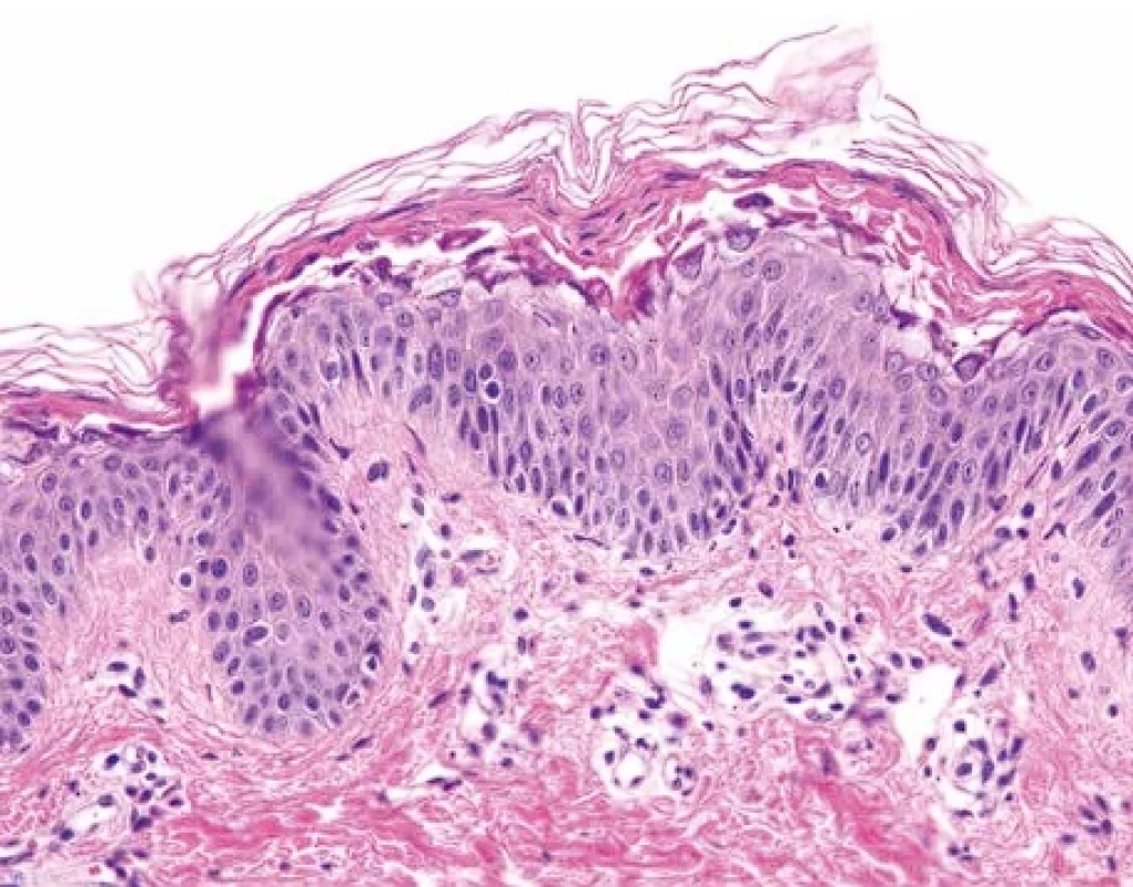 Stafylokokový syndrom opařené kůže – histopatologický obraz. Intrakorneální akantolýza a separace keratinocytů s tvorbou plošného puchýře. Hematoxylin-eozin, pův. zvětšení 400.