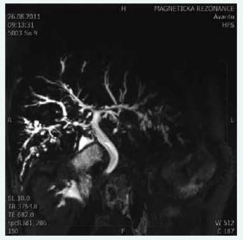 Cholangiogram u pacienta s PSC. Typické
změny zachycené při MRCP: vícečetné
segmentální striktury a dilatace žlučového
stromu s charakteristickým „korálkováním“