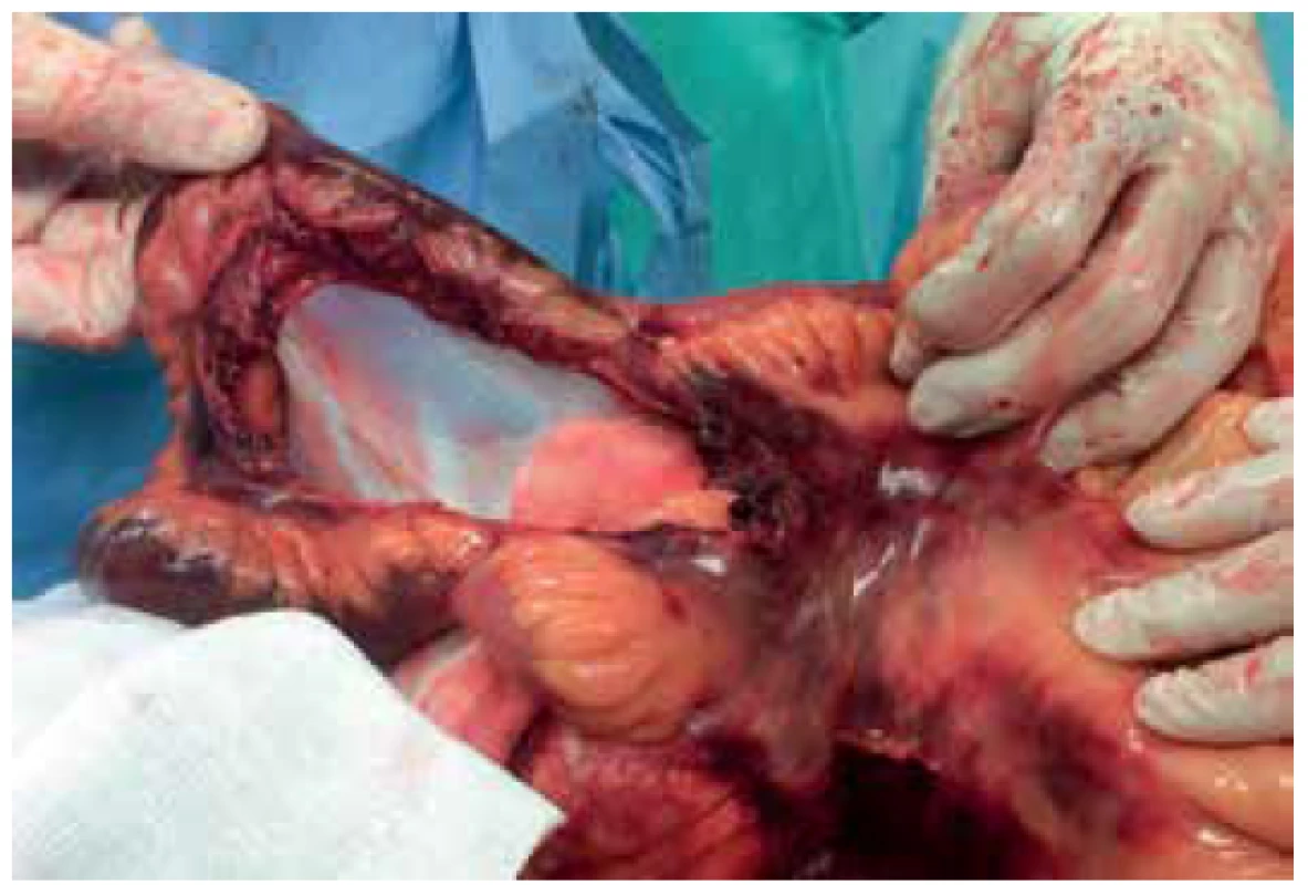 Poranění tenkého střeva grade V: avulze střeva<br>
Fig. 3. Small intestine injury grade V: avulsion