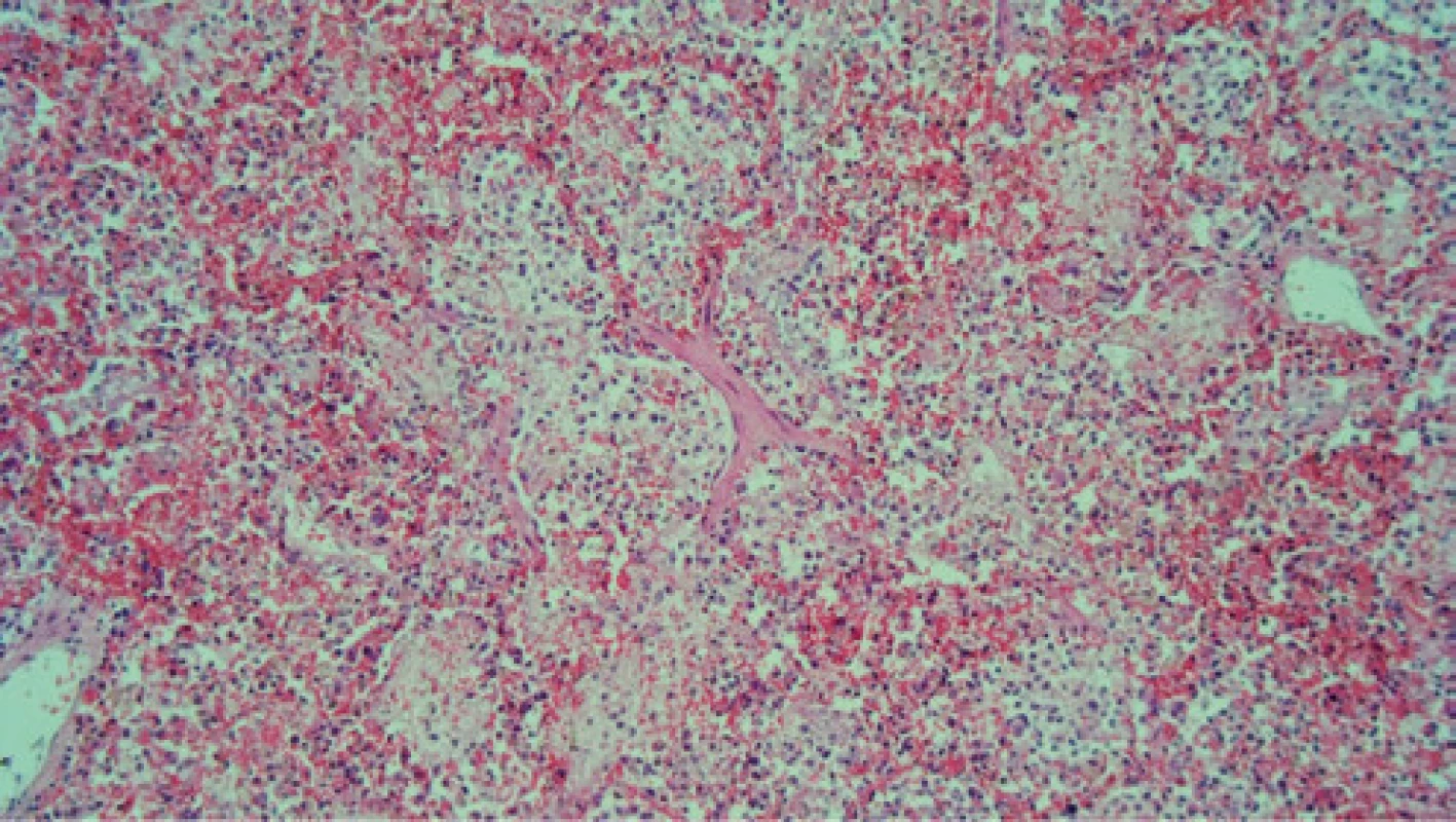Histológia (dolný lalok pľúc, HE, 100×) – obraz sekundárnej infekcie a krvácania do pľúcneho parenchýmu, v alveolárnych priestoroch je 
zachytený najmä zápalový exsudát – početné neutrofily a hojne nakopené 
extravazáty erytrocytov