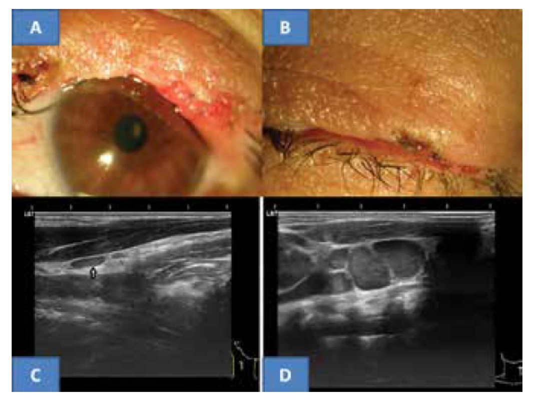 Klinický nález horního víčka pět let po operaci MCC
u nyní 53-leté pacientky (A), spontánní dovření oční štěrbiny (B),
typická plochá benigní reaktivní uzlina v oblasti musculus sternokleidomastoideus
vpravo u naší pacientky (C) a pro srovnání ukázka
paketu maligních převážně skoro kulovitých uzlin s jasným echogenním
stromatem (archiv MUDr. J. Zikmund, CSc.) ve stejné oblasti (D)