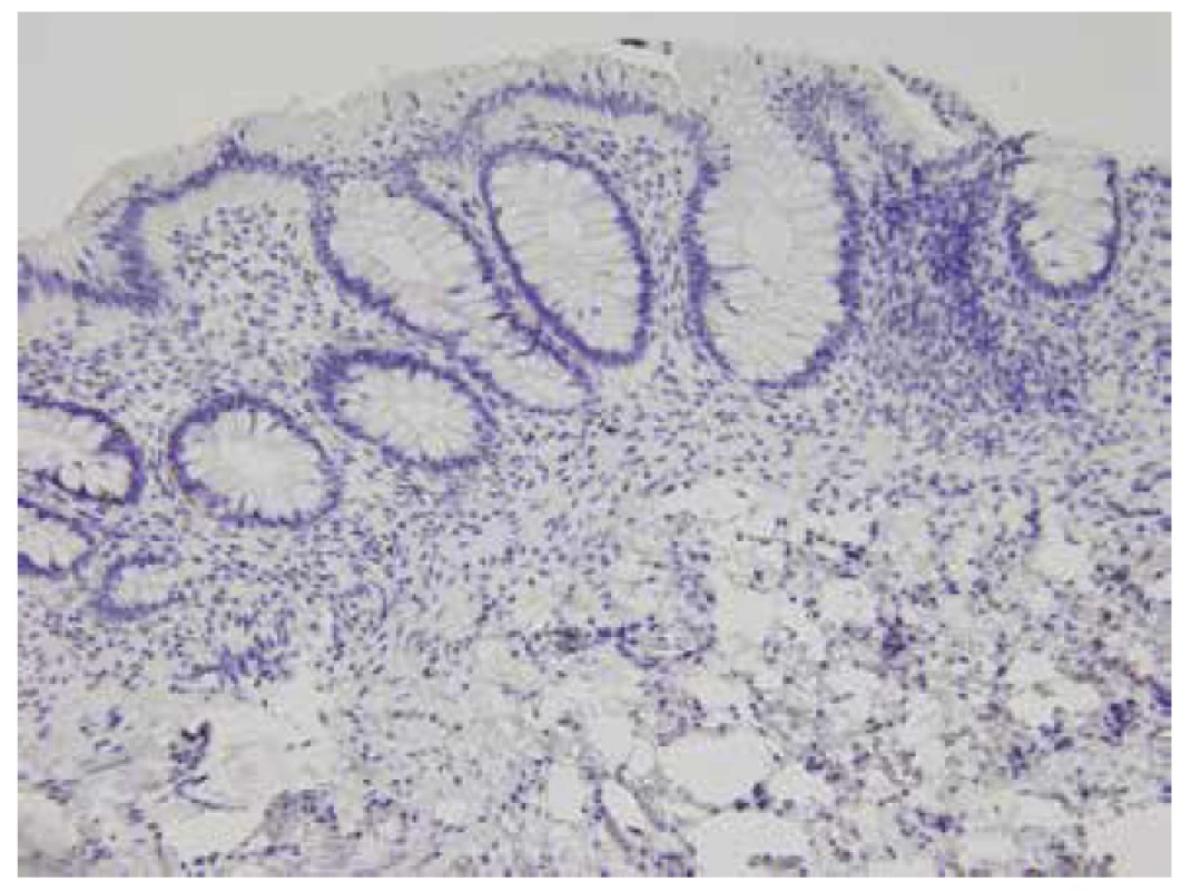 Negativní imunohistochemický průkaz kalretininu v lamina propria
i muscularis mucosae, HN (200x).