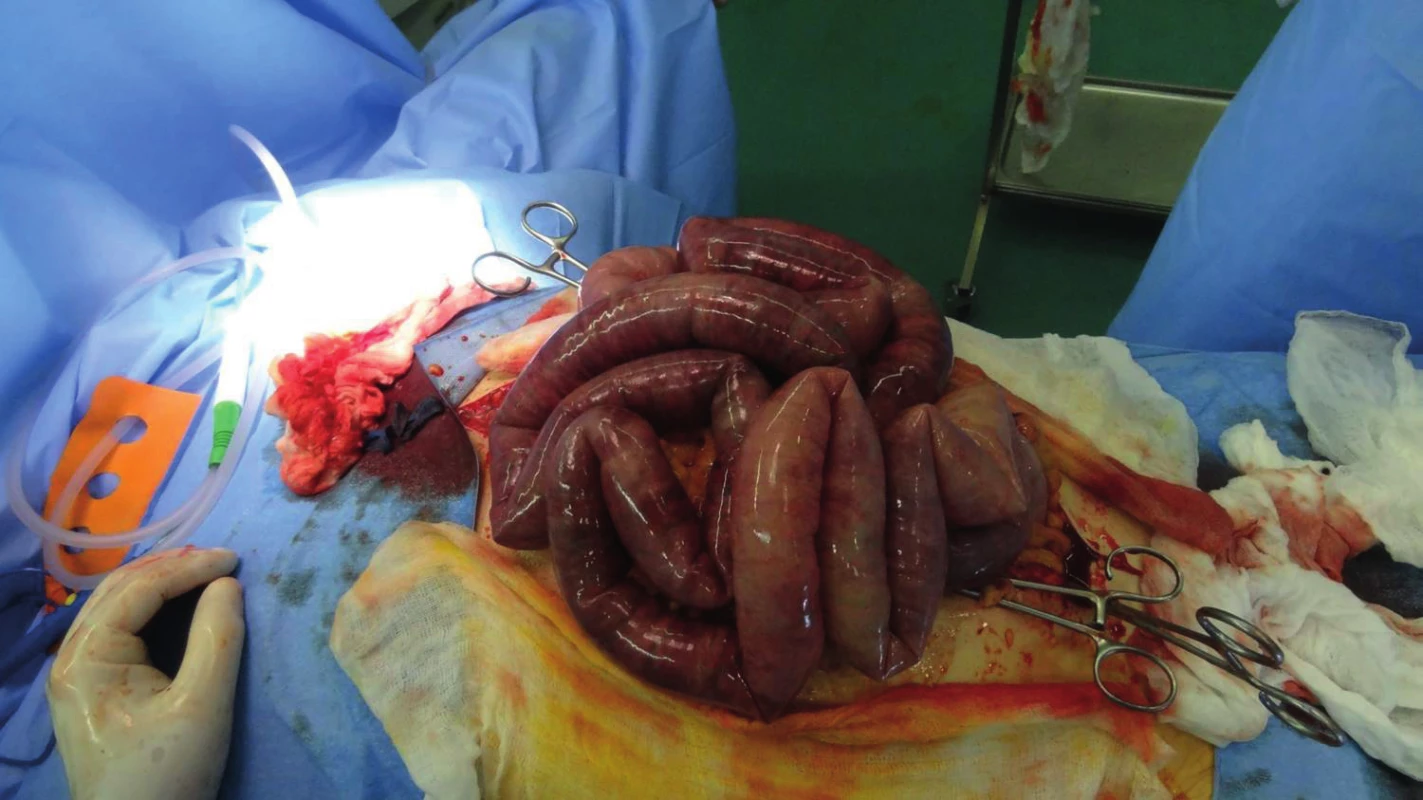 Necrosis of a loop of small bowel in a patient with developed ACS
