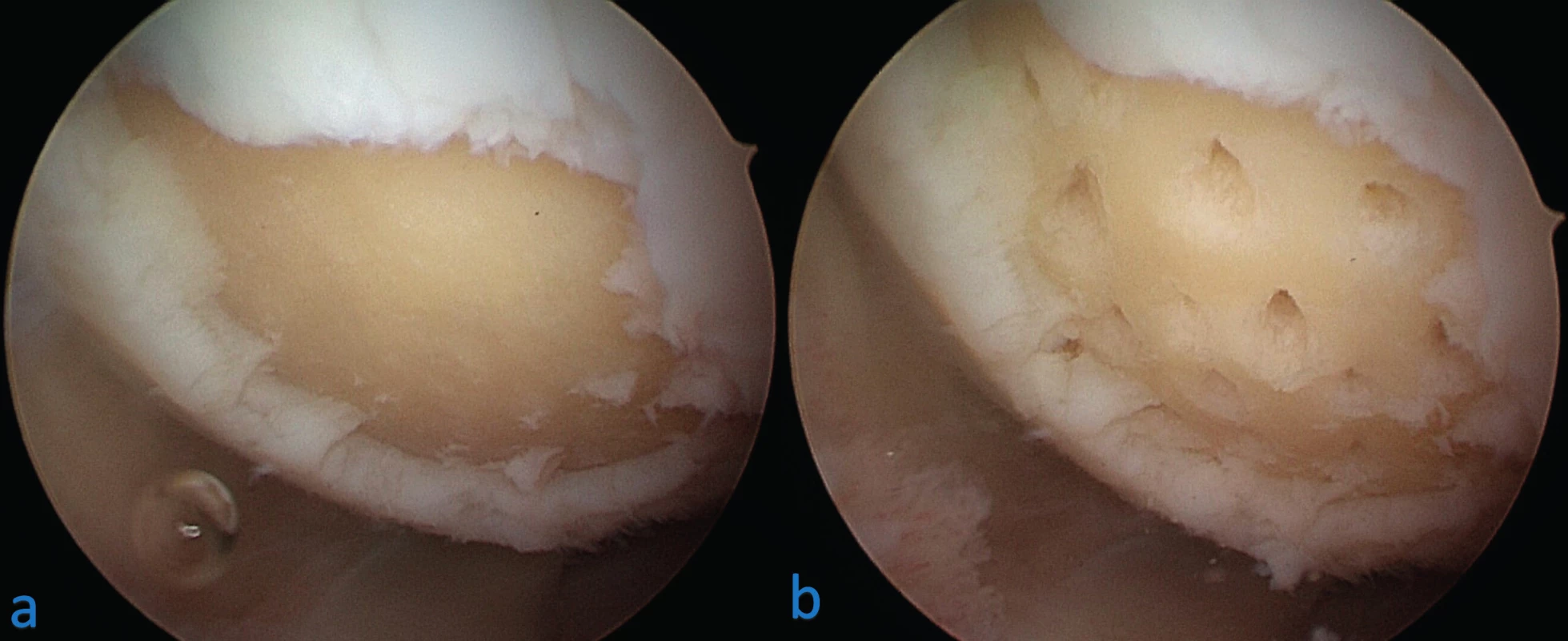Mikrofraktury chondrálního defektu mediálního kondylu femuru levého kolene: a – stav po provedení debridementu spodiny
a okrajů defektu, b – stav po provedení mikrofraktur spodiny pomocí šídla 
