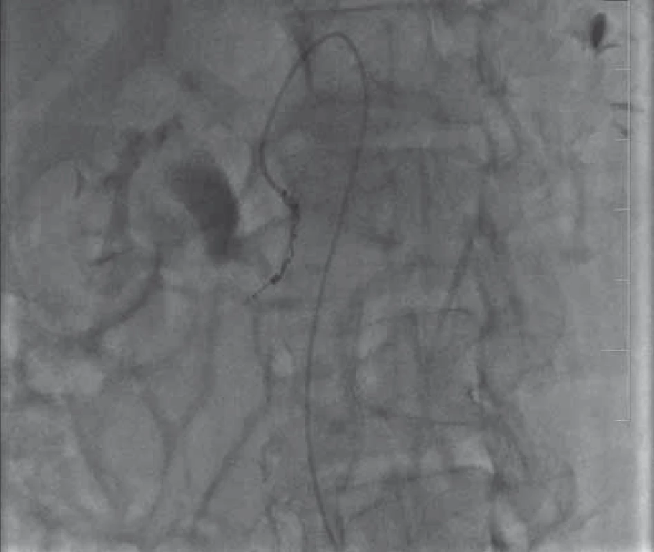 Angiografie – dva coily zavedené do poškozené
tepny.
Fig. 3. Angiography – two coils inserted into the affected
artery.
