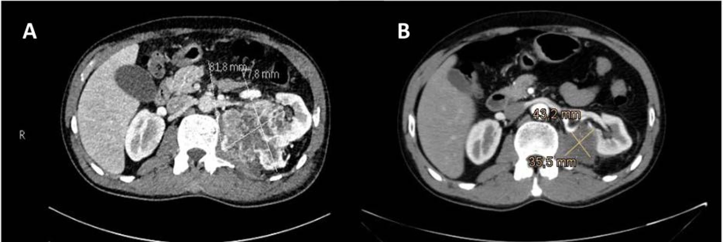 CT vyšetření ledvin se zobrazením primárního nádoru levé ledviny v době diagnózy (A); kontrolní CT vyšetření
po tříměsíční léčbě sunitinibem prokázala výraznou regresi primárního nádoru, bez sycení tkáně; denzita odpovídala
fibrotické tkáni, centrálně pak nekróze (B)<br>
Fig. 2. CT scan of the kidneys showing primary left kidney tumor at the time of diagnosis (A). Control CT examinations
after three months of sunitinib treatment showed significant regression of the primary tumor, without
tissue enhancement. The density corresponded to fibrotic tissue with central necrosis (B).