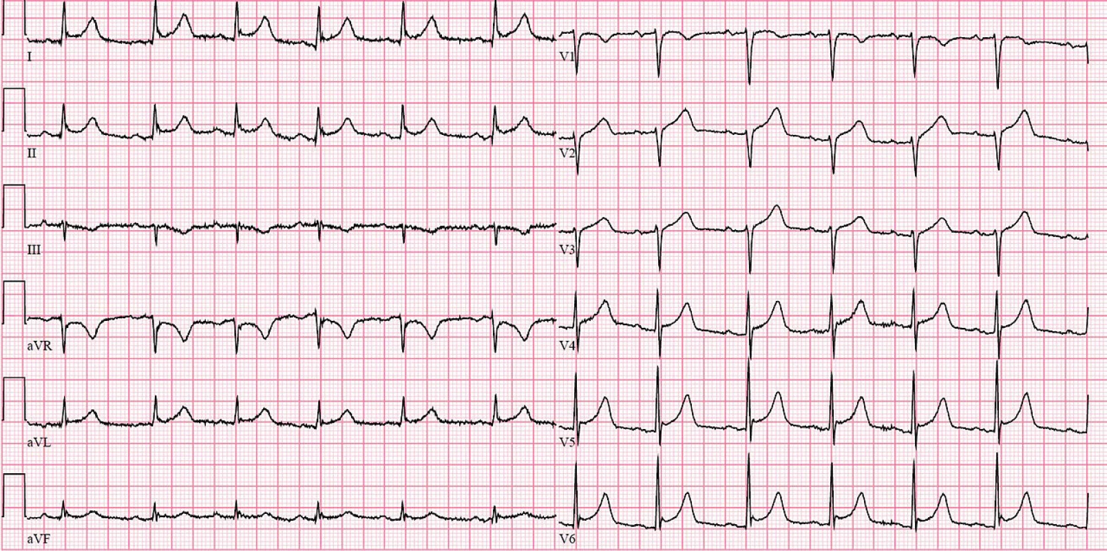 EKG křivka