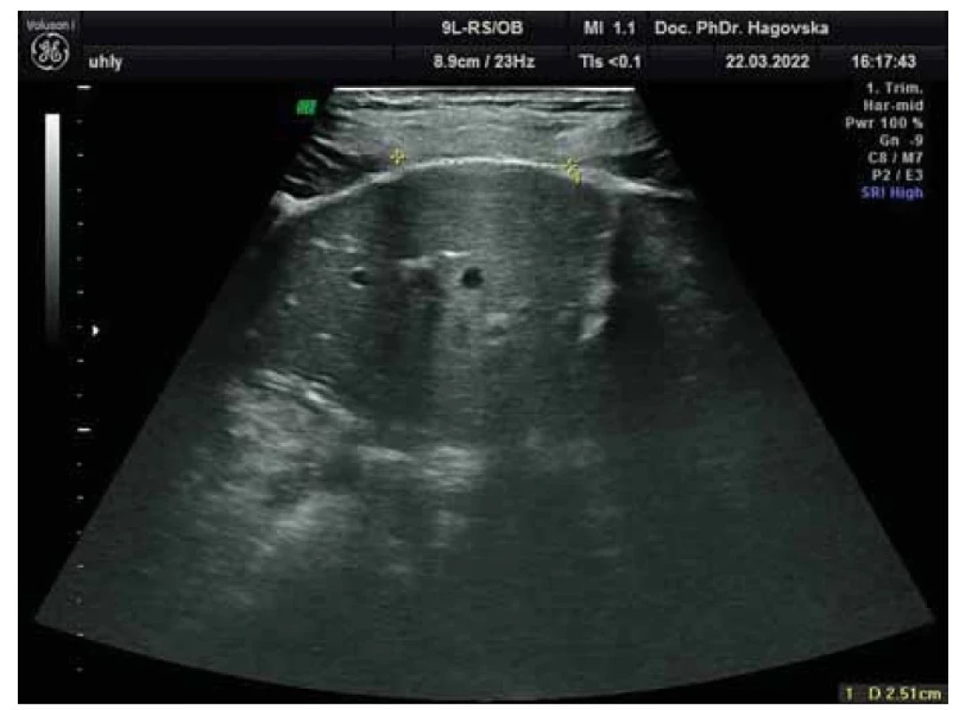 Vyšetrenie diastázy m. rectus abdominis 2D ultrazvukom.<br>
Fig. 2. Examination of the diastasis of m. rectus abdominis by 2D ultrasound.