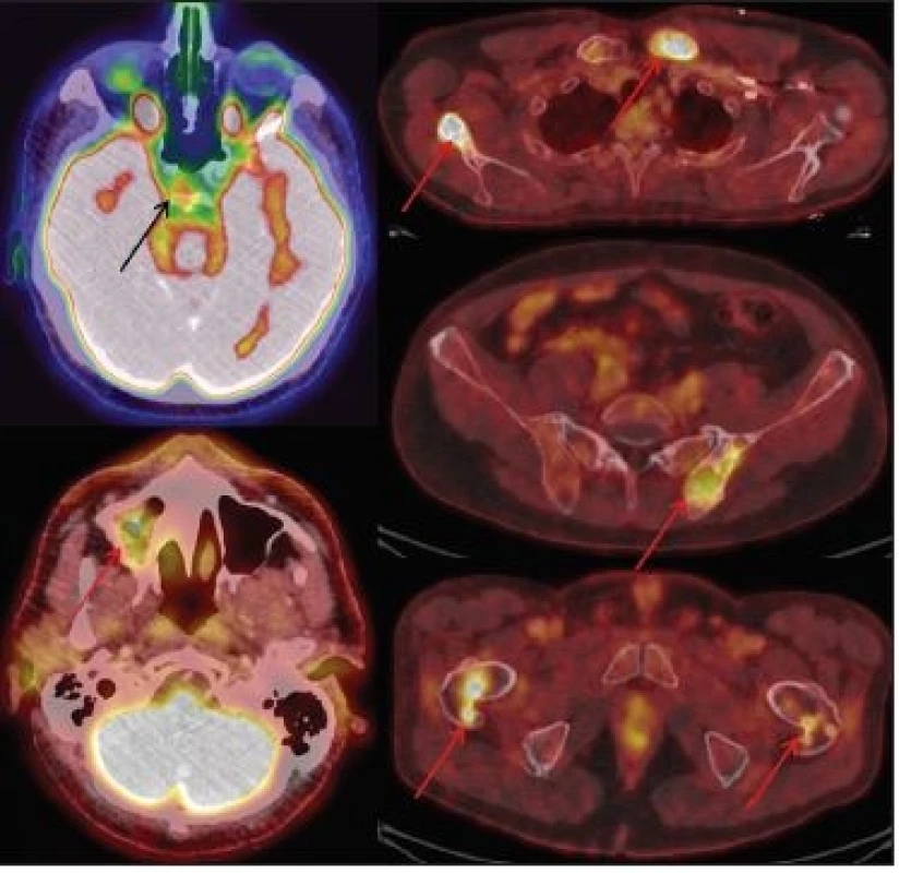 (vpravo) Sumarizace
nálezů <sup>18</sup>F-FDG PET/CT vyšetření
u pacienta č. 6. Černobílá
MIP projekce ukazuje rozsah
snímání, odráží i rozsah kostního
postižení. Fúzované obrazy
pak ukazují detaily kostního
postižení v úrovní distálních
femurů, proximálních a distálních
tibií.