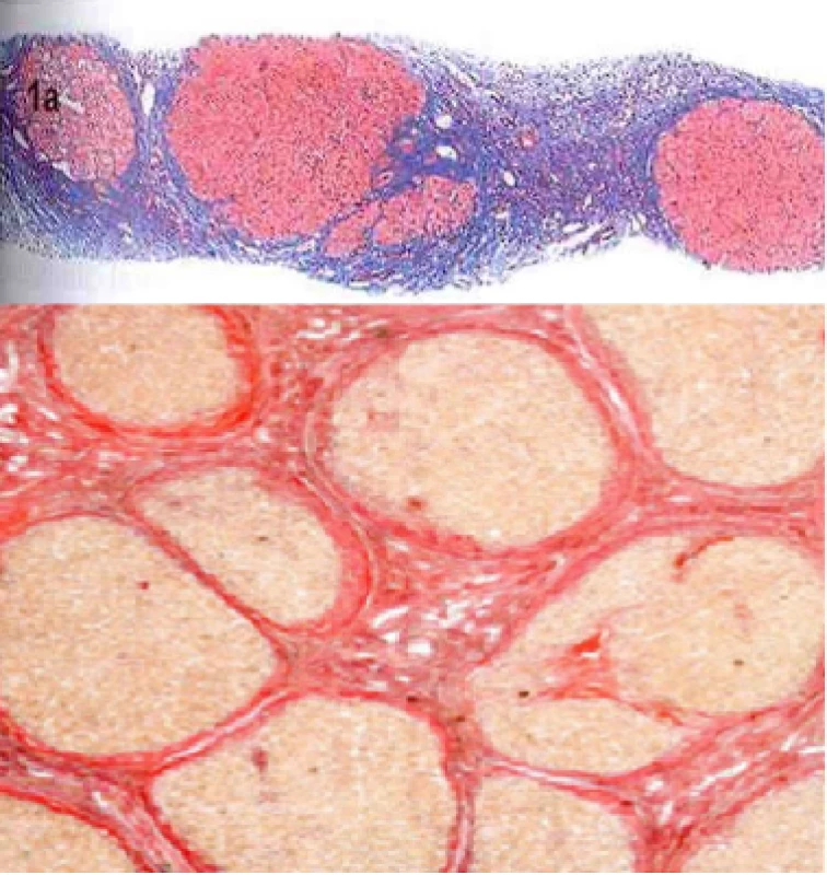 Histologický obraz mikronodulární jaterní cirhózy při různých zvětšeních