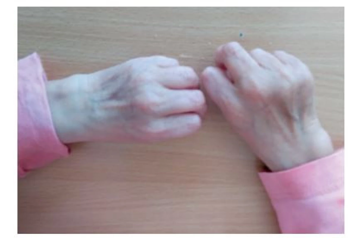 Ruky pacientky vo veku 5,5 roka so „stareckým“ vzhľadom
s tenkou zvráskavenou kožou.