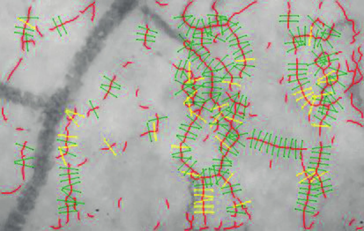 Vyhodnocování parametru PBR programem
GlycoCheck. Červené linky znázorňují cévy o průměru 5–25
mm, zelené linky oddělují hodnocené vaskulární segmenty,
žluté linky oddělují neplatné segmenty. (Autor: MUDr. David
Astapenko)