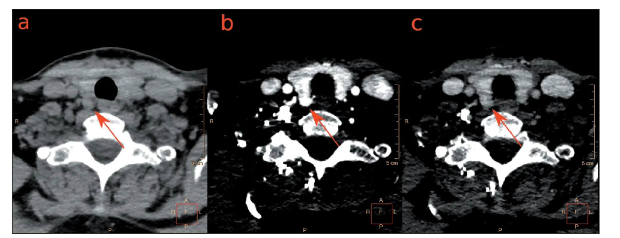 Fázové axiální 4D CT obrazy u pacientky s primární hyperparatyreózou.<br>
Dorzálně od pravého laloku štítné žlázy se zobrazuje uzel (a) nativně hypodenzní, (b) v arteriální fázi hyperdenzní, (c) ve venózní fázi prakticky
isodenzní s parenchymem štítné žlázy. Operačně a histologicky potvrzen adenom PT. Obrazy zapůjčeny s laskavostí MUDr. Vladimíra
Černého Ph.D. z Radiologické kliniky VFN Praha.