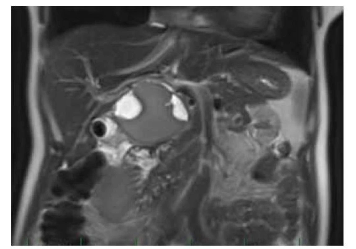 MR: cystické ložisko utlačující d. choledochus
s vícečetnými T2W hypersignálními porcemi.<br>
Fig. 4. MRI: cystic lesion oppressing the d. choledochus with
multiple T2W hypersignal portions.