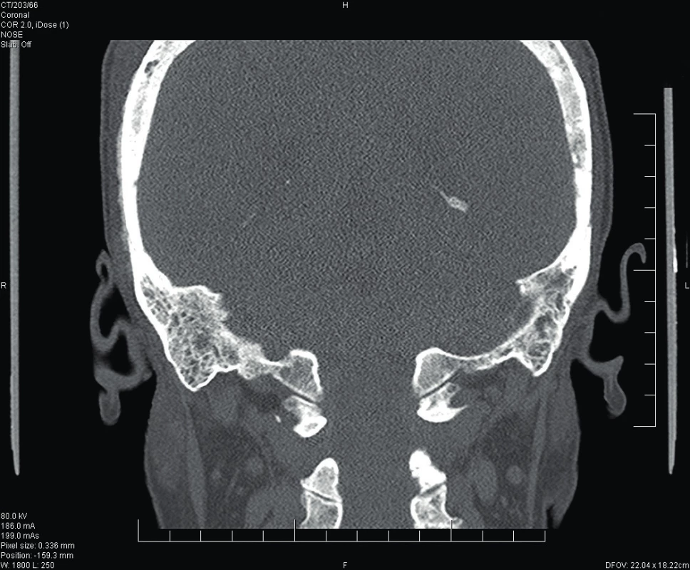 CT předoperačně, zobrazení temporálních kosti (koronární
projekce).
