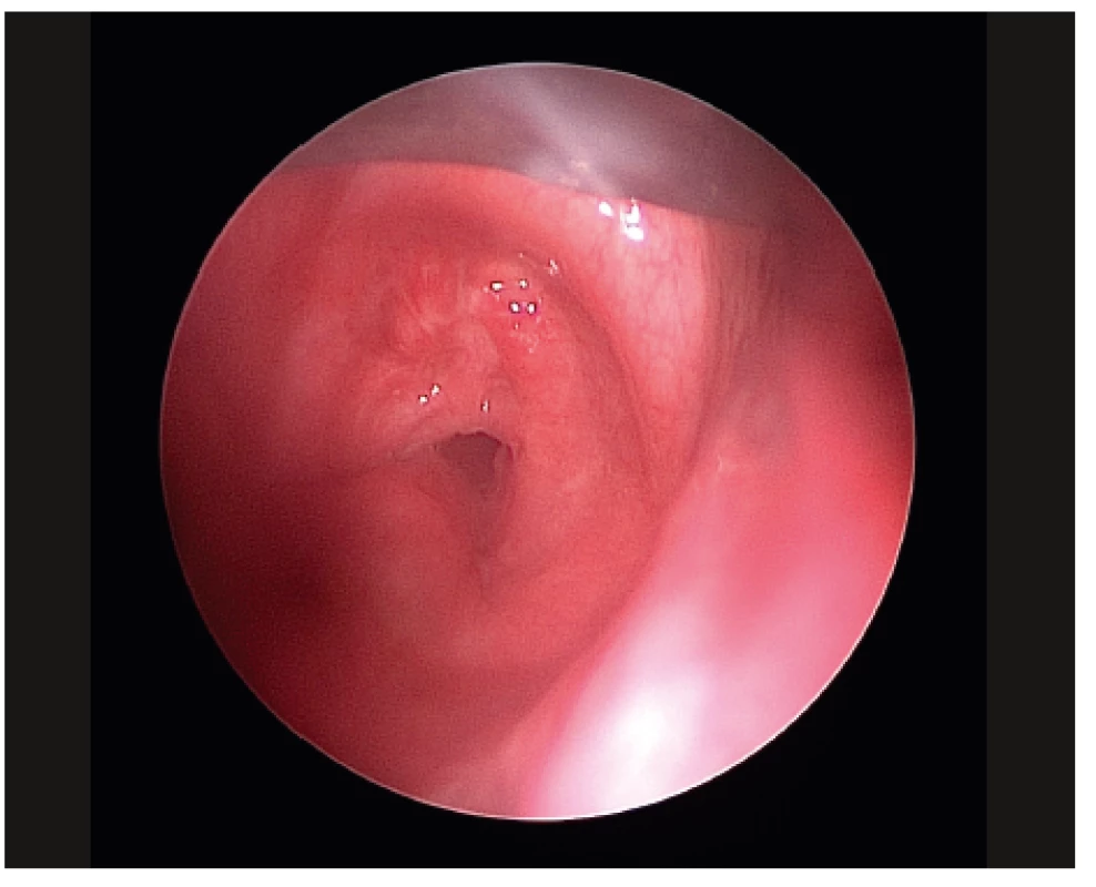 Bronchoskopický nález před zavedením stentu - jizevnatá
cirkulární stenóza trachey.