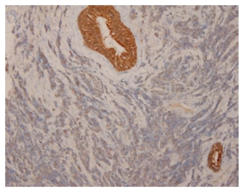 Granulární cytoplazmatická pozitivita malobuněčného karcinomu
v imunohistochemickém průkazu cytokeratinu AE1/AE3, kontrastující se silnou
cytoplazmatickou pozitivitou výstelky žlázky. 100x.