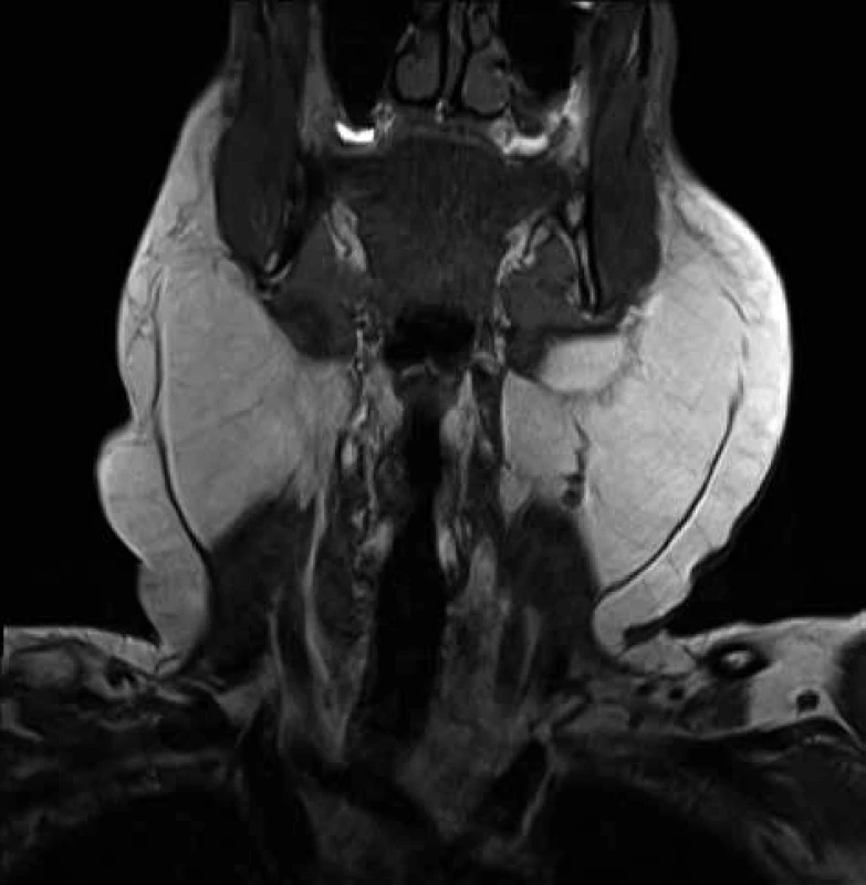 MRI krku s laterálně uloženými lipomy<br>
Fig. 4: MRI of neck with laterally deposited lipomas