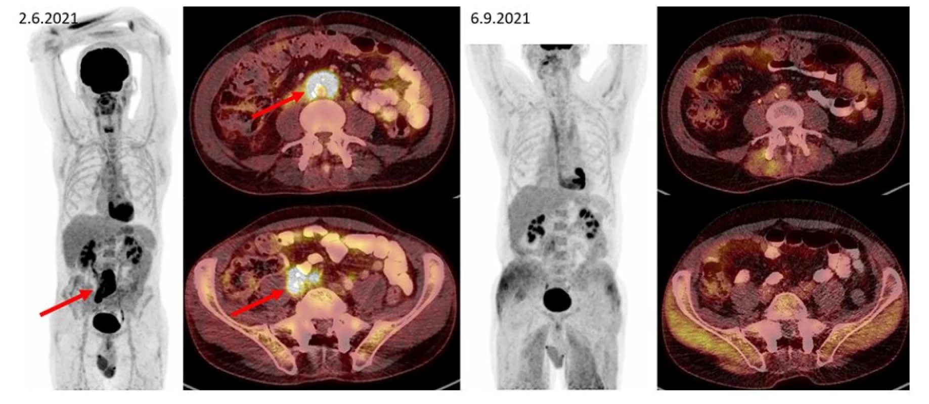 F–FD6 PET/CT vyšetření u pacienta s ložiskem retroperitoneální fibrózy s histologicky potvrzenou diagnózou IgG4-RD. Šipkami jsou označeny
kraniální i kaudální porce metabolicky aktivní infiltrace v retroperitoneu obkružující kaudální část břišní aorty, oblast bifurkace a dále odstup pravostranných
společných ilických cév (v infiltrátu je zavzat pravostranný ureter s JJ stentem). Pacient byl léčen rituximabem, dexametazonem a cyklofosfamidem.
Po této léčbě tato metabolicky aktivní infiltrace při kontrolním vyšetření zaniká. Další akumulace radiofarmaka v rámci variant fyziologického zobrazení