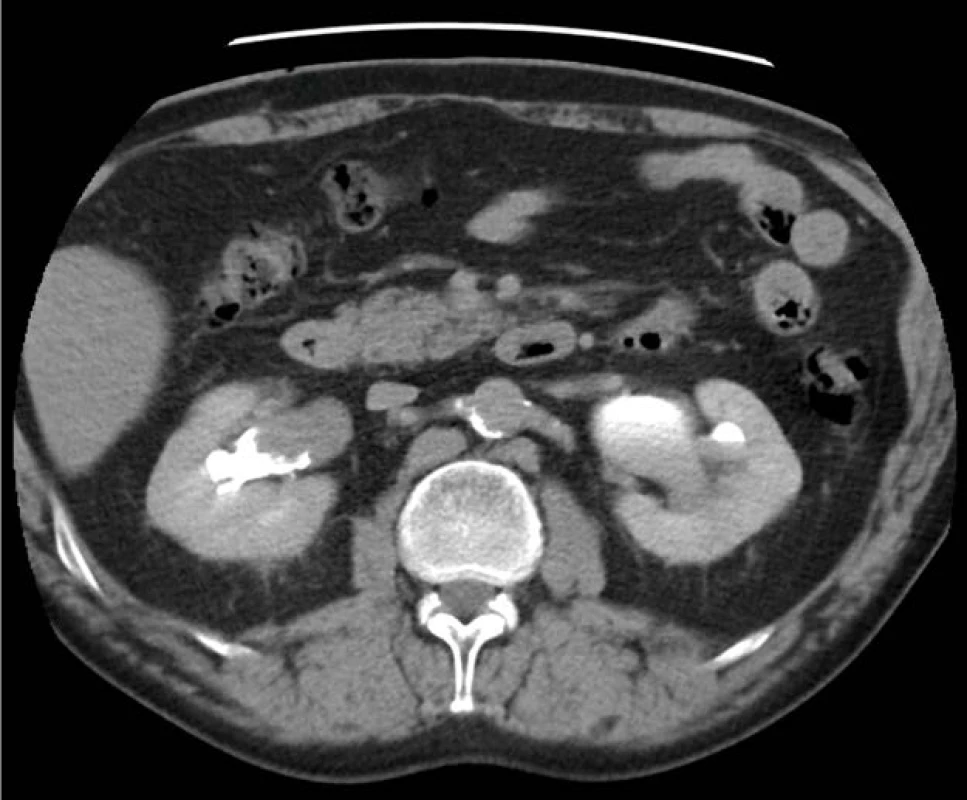CT-IVU – tumor ledvinné
pánvičky vpravo na transverzálním
řezu (zdroj: Krajská zdravotní, a. s.)<br>
Fig. 1. CT-IVU – tumor of right
renal pelvis (transverse plane)