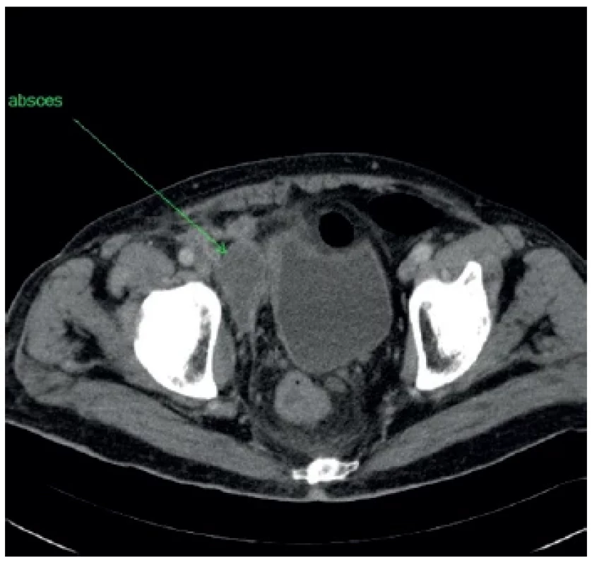 Rozšírenie abscesu do malej panvy <br> 
Fig. 4. Extension of the abscess into the small pelvis