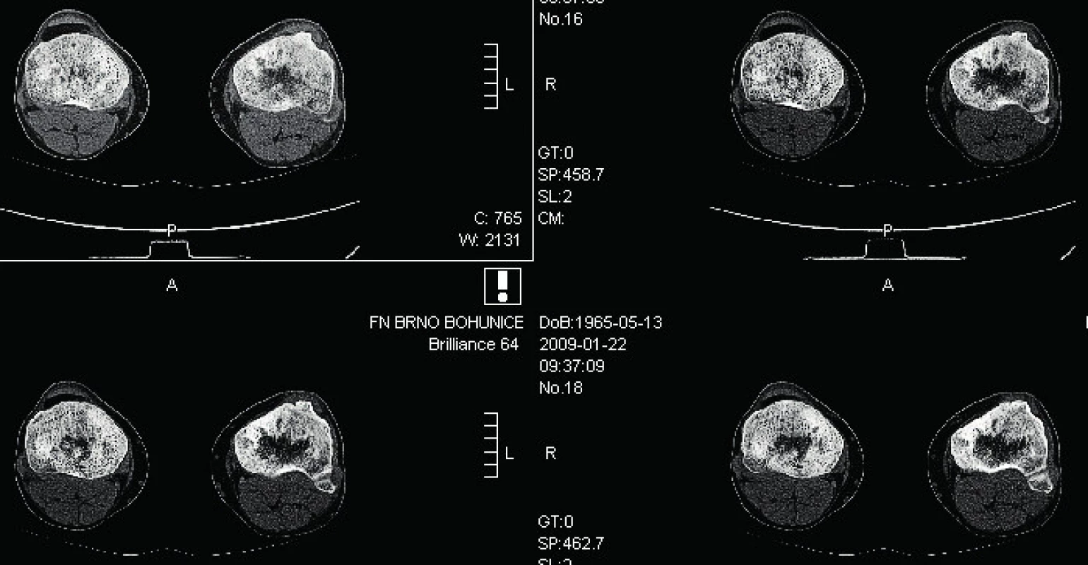  CT zobrazení tibie při ECD: koronární řez, patrné zesílení
kompakty