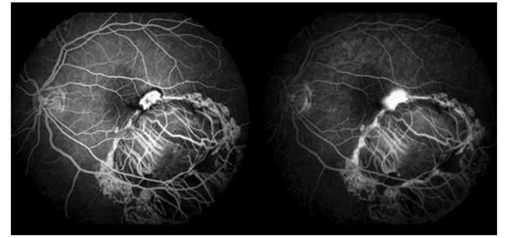 Fluoroangiografické vyšetrenie ľavého oka, skorá a neskorá fáza s presakovaním v mieste CNV (2019)