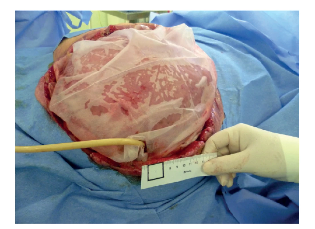 Katétr v píštěli<br>
Fig. 2: Catheter in the fistula