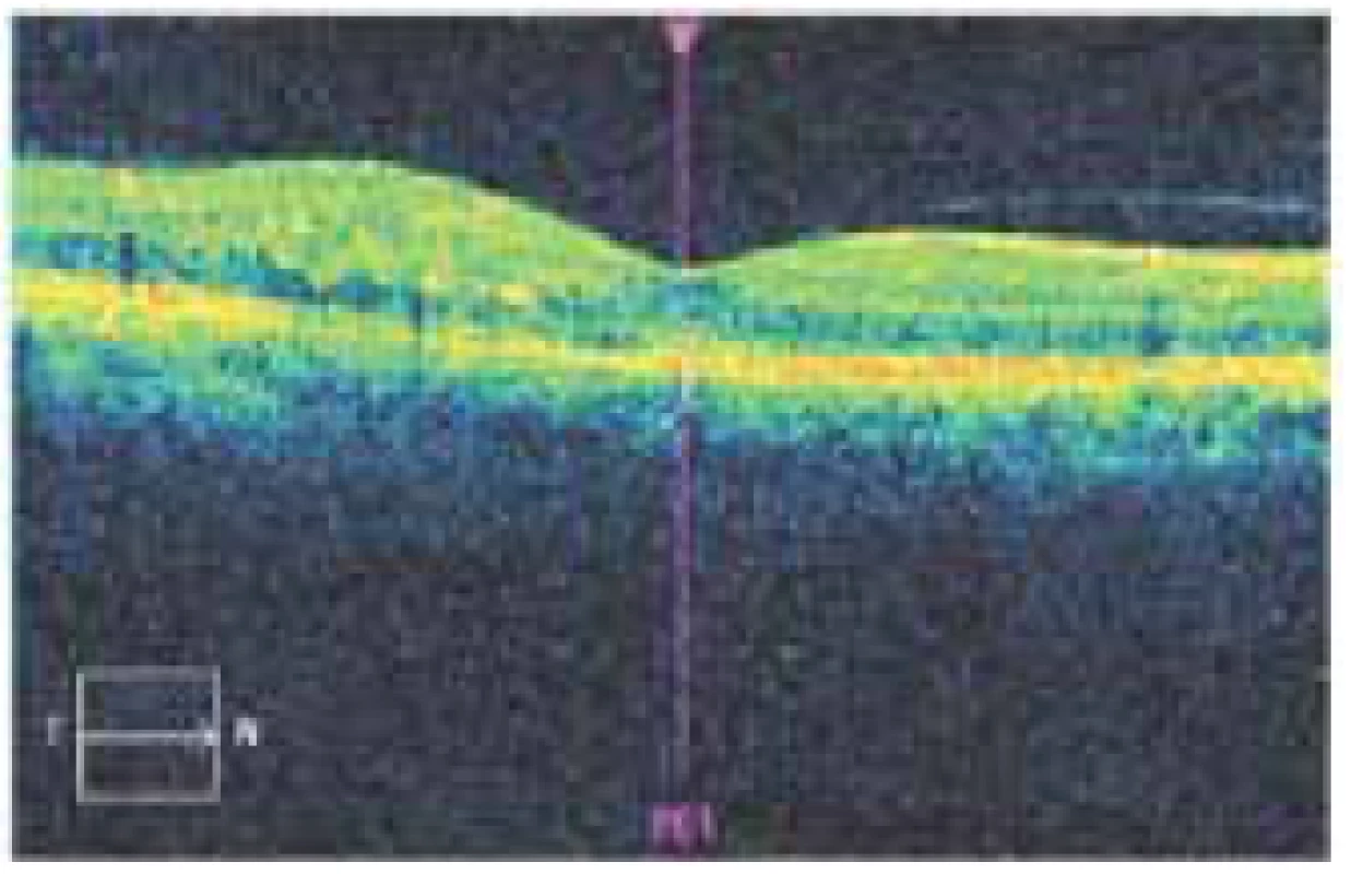 Snímek optické koherenční tomografie u téhož
pacienta pořízený po 3 intravitreálních injekcích ranibizumabu,
centrální retinální tloušťka 292 μm, reziduální
edém v horních části centrální krajiny, nejlepší korigovaná
zraková ostrost 6/7,5. Další injekce nebyly indikovány,
reziduální edém se bez další nutnosti replikace spontánně
vstřebal, pacient po dobu dalšího roku sledování udržel
zrakovou ostrost 6/6