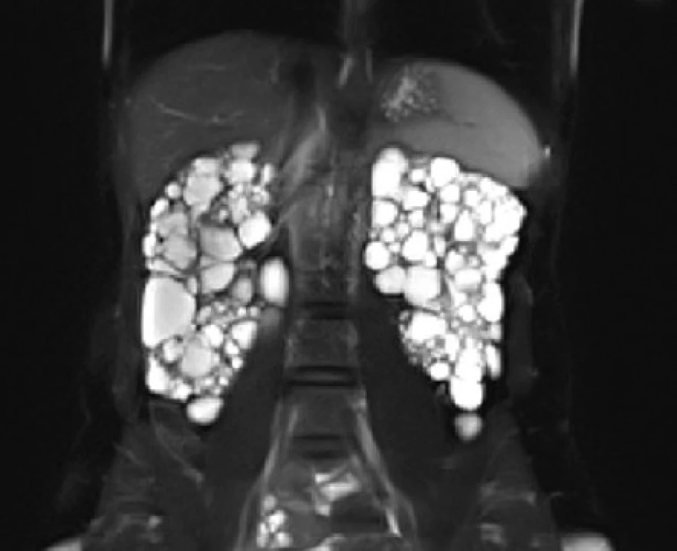 MRI, koronární řez. Polycystické ledviny u nemocné s tuberózní sklerózou<br>
Fig. 9. MRI scan, coronal plane. Polycystic kidneys of
the patient with tuberous sclerosis