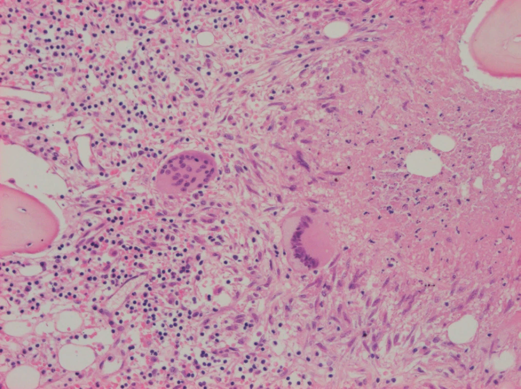Trepanobiopsie kostní dřeně. Barvení Hematoxylin + Eozin (H+E),
zvětšení 100×. Vlevo trilineární hematopoéza, uprostřed Langhansovy
mnohojaderné buňky, vpravo poprašková nekróza, vpravo dole
epitelioidní buňky, vpravo nahoře kostní trámec.