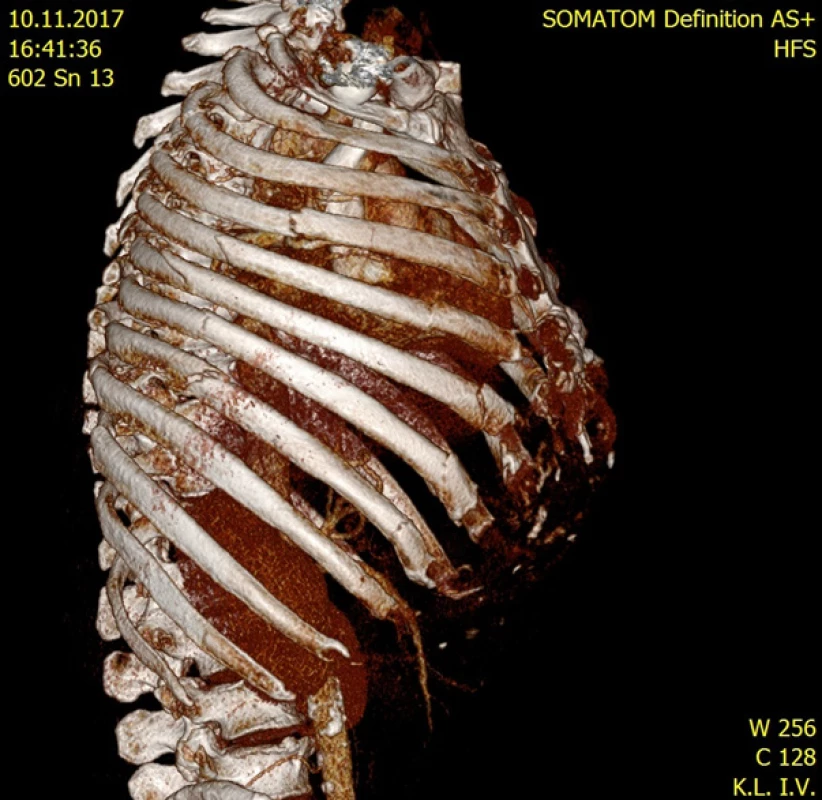 MD CT hrudníku u zraněného s polytraumatem
ve věku > 65 let s nálezem blokové zlomeniny žeber
(3.–7. žebro vpravo)