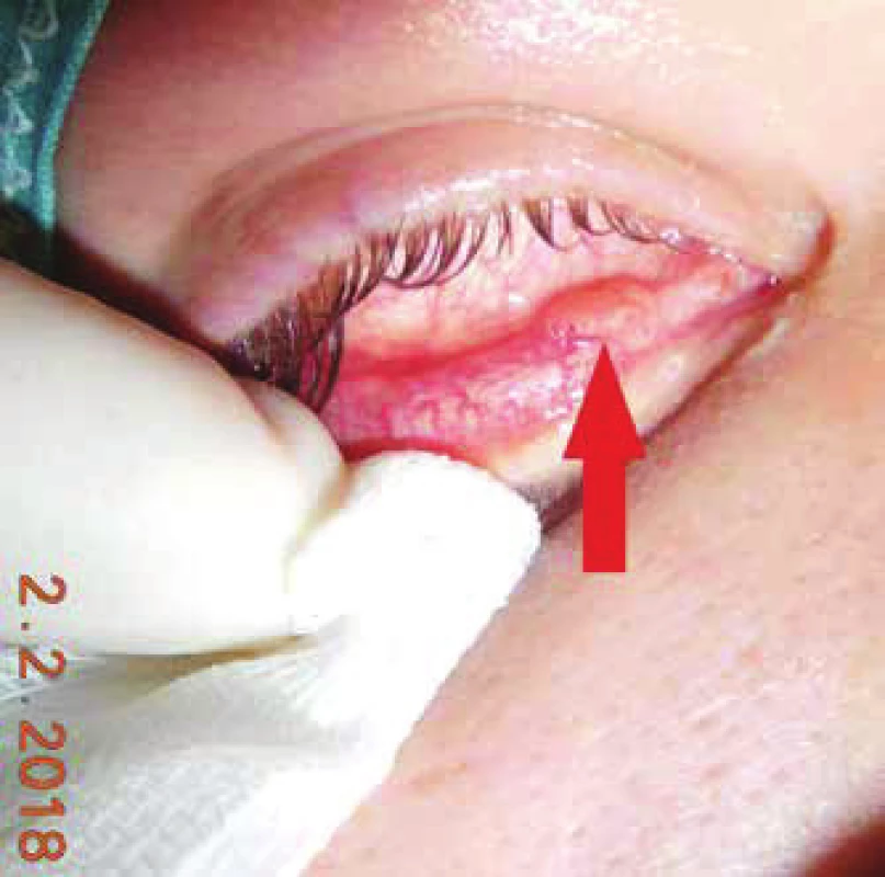 Klinický obraz u pacienta s papilómom spojovky na vnútornej
strane dolnej mihalnice