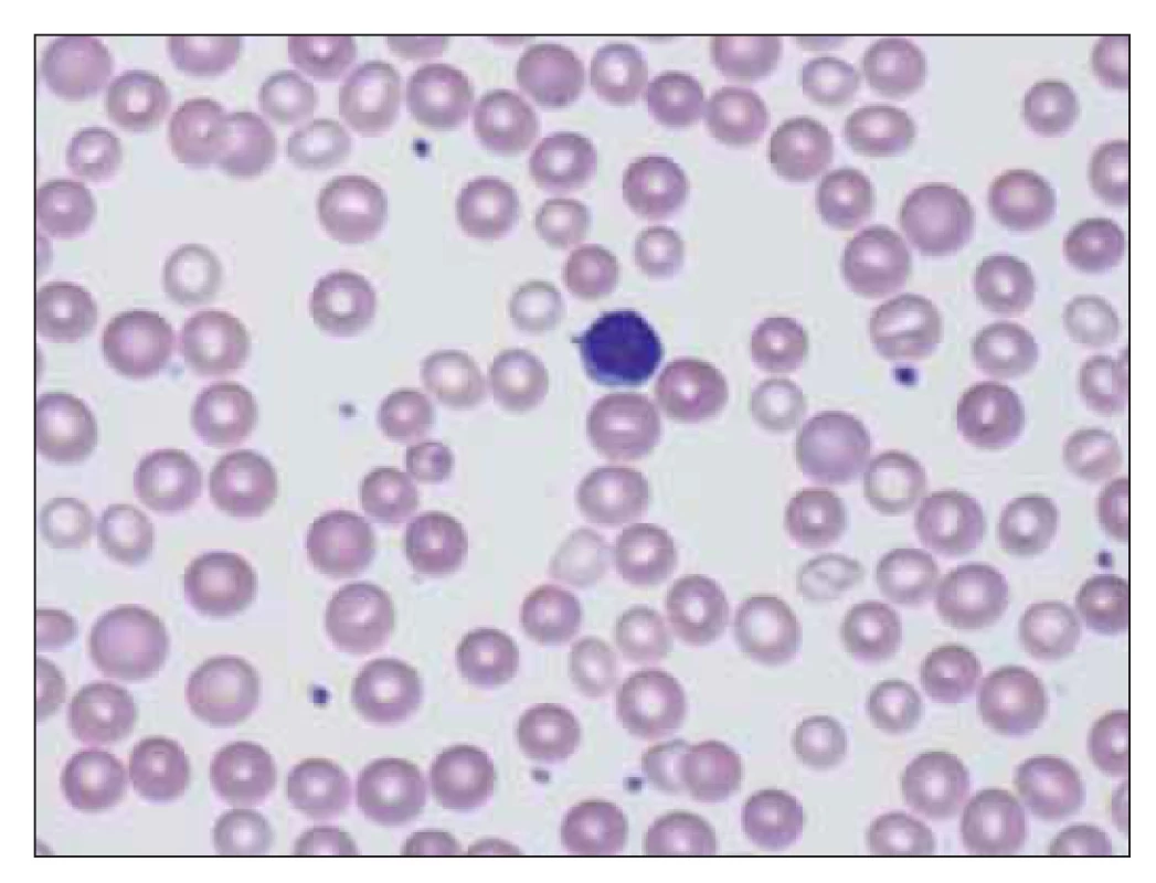 Mikrocyty a normocyty v nátěru periferní krve –
nemocný po léčbě defi citu železa (zdroj: laboratoř IV. IHK).