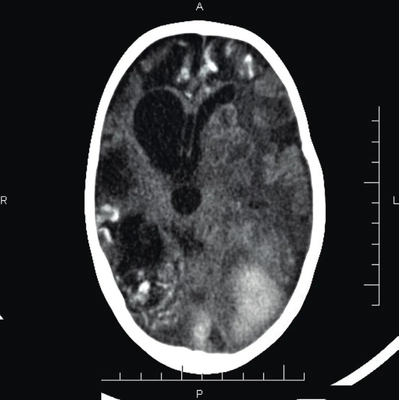CT mozgu (vo veku 2 r. 6 mes.) – významná progresia
nálezu s rozsiahlym krvácaním okcipitálne vľavo, hyperdenzity
v subarachnoidálnych priestoroch nad pravou
hemisférou a okcipitálne obojstranne – kalcifikáty
po zakrvácaní. Asymetrický komorový systém, rozšírené
III. a IV. komora, presun stredočiarových štruktúr.<br>
Fig. 4. Brain CT (age 2 years 6 months) – significant progression
of findings, extensive intraparenchymal heamorage
in the left occipital lobe, hyperintesities in the
subarachnoid space over the right hemisphere – calcificates
after heamorrhage. Asymetric ventricular enlargement
of the III and IV ventricle and midlines shift.