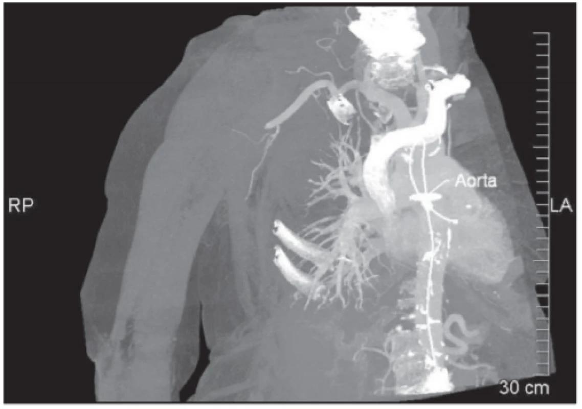 SCT angiografické vyšetření s nálezem uzávěru a. axillaris
a a. brachialis vpravo