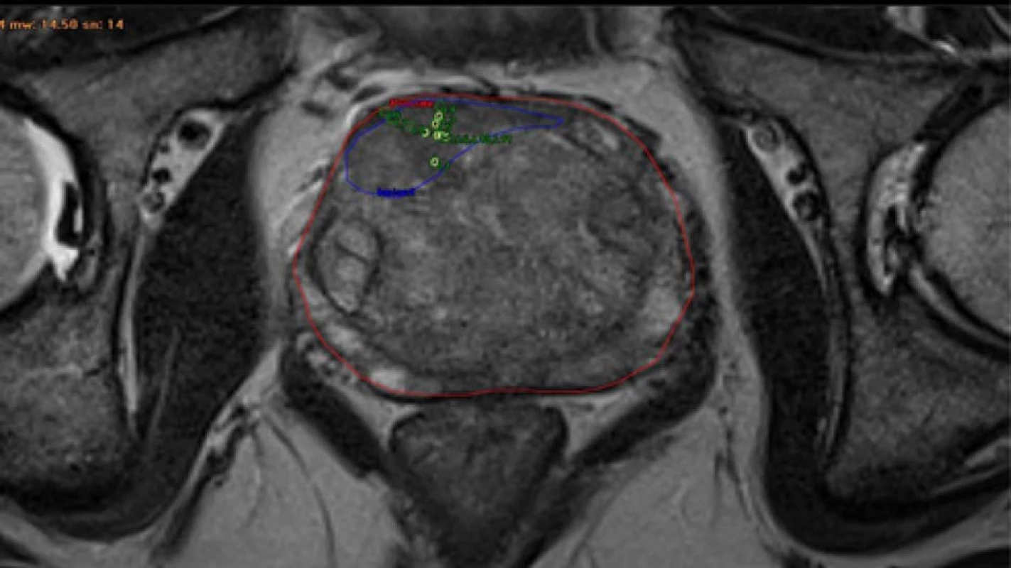 T2 vážená sekvence mpMRI transverzální řez; červeně – prostata; modře – suspektní ložisko KP; zelenožlutě
– bioptické vzorky<br>
Fig. 1. T2 weighted sequence mpMRI axial view; red – prostate; blue – suspect lesion of prostate cancer; greenyellow
– bioptic patterns