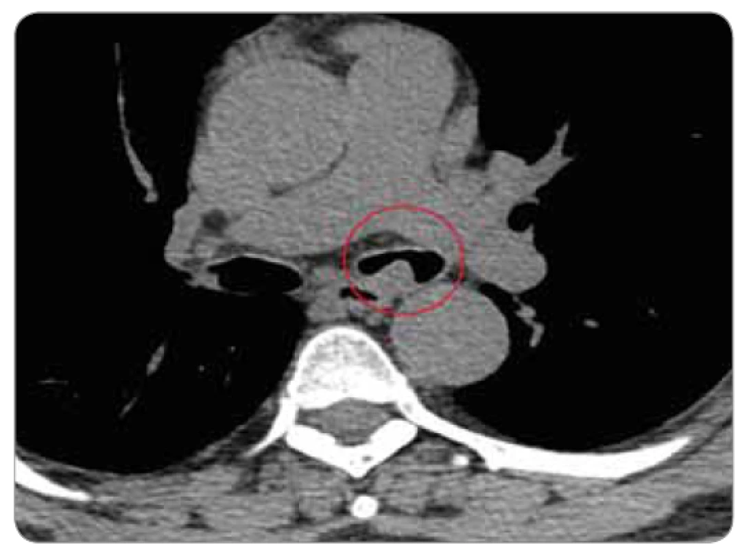 Detail patologie na CT – karcinoid vyrůstající v levém
hlavním bronchu.