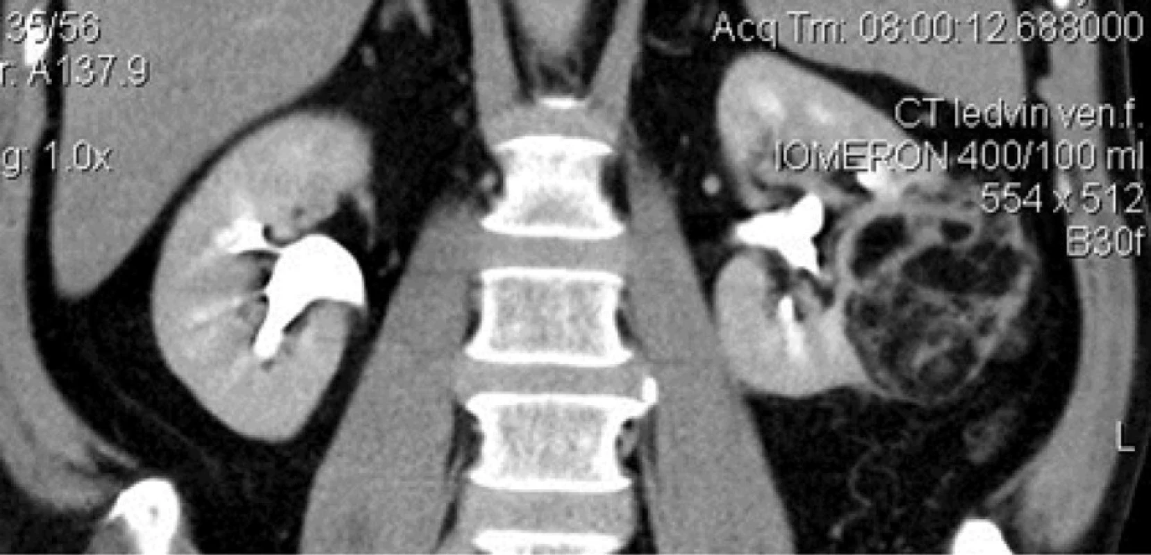 Angiomyolipom levé ledviny CT (koronární řez)<br>
Fig 1. Angiomyolipoma of the left kidney CT (transverse section)